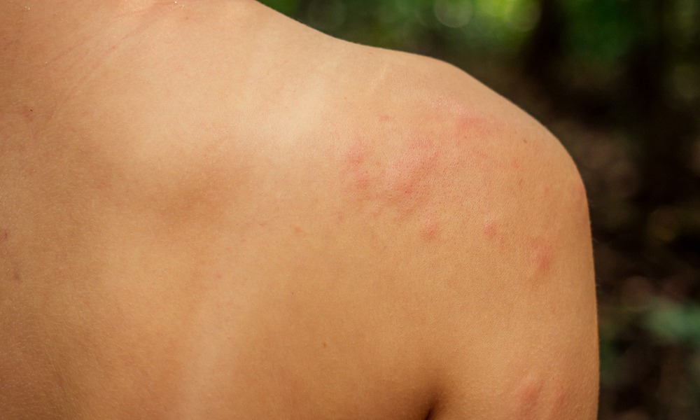 urgent care bug bite