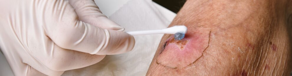 WOUND CARE AT HOME: ALL YOU NEED TO KNOW
