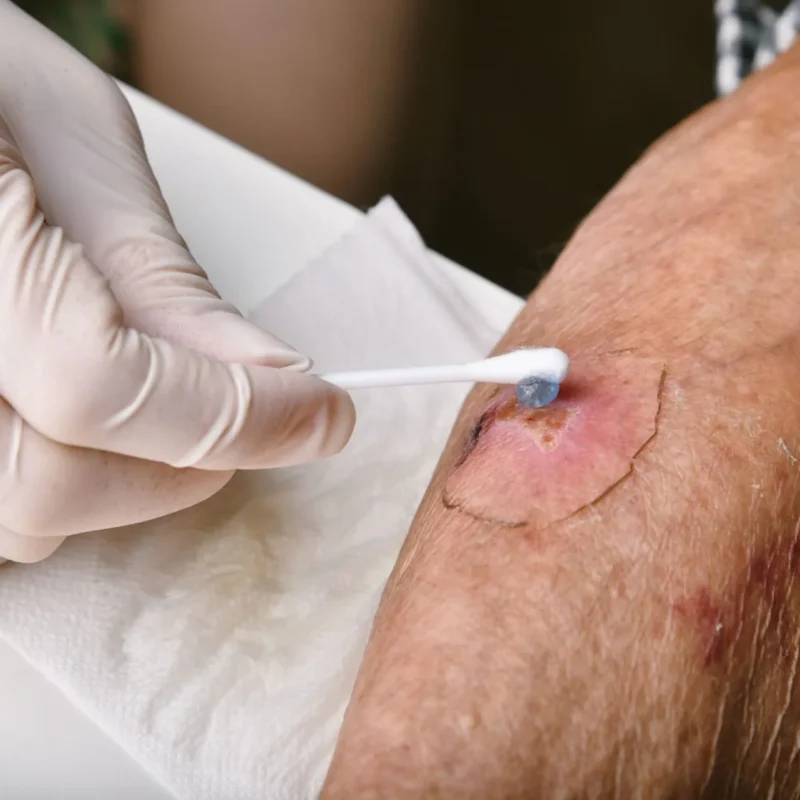 at home wound care