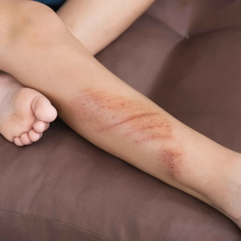 Scratches, Scrapes, and Cuts: Infected Wound Prevention and Care
