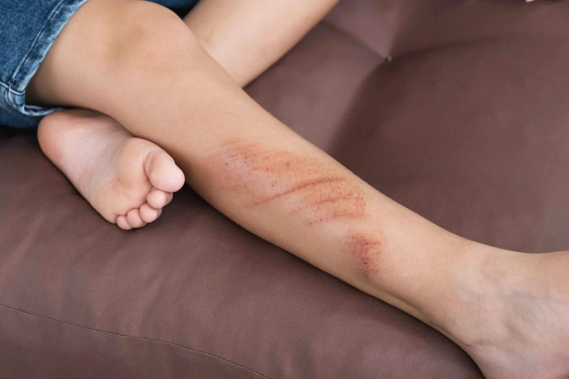 Scratches, Scrapes, and Cuts: Infected Wound Prevention and Care