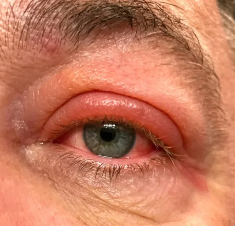 swollen eyes bumps