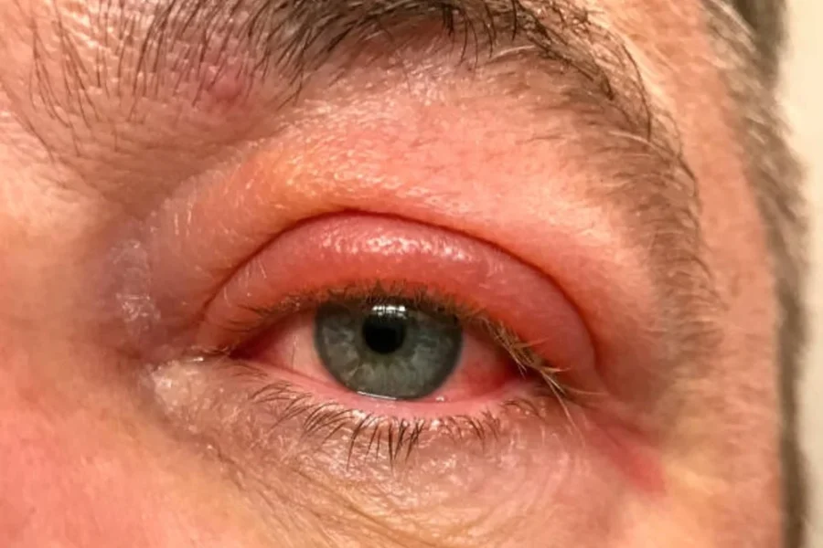 swollen eyes bumps