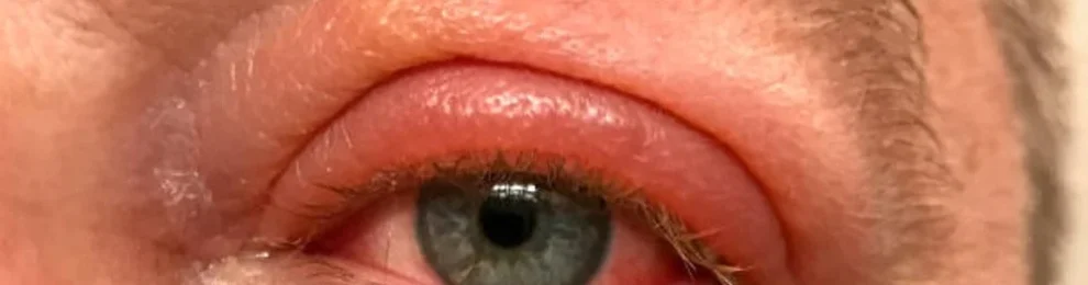 Red Bump on Your Eyelid: Causes, Symptoms, and Treatment Options