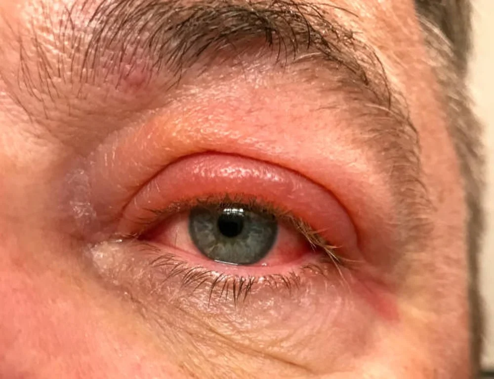 Red Bump on Your Eyelid: Causes, Symptoms, and Treatment Options