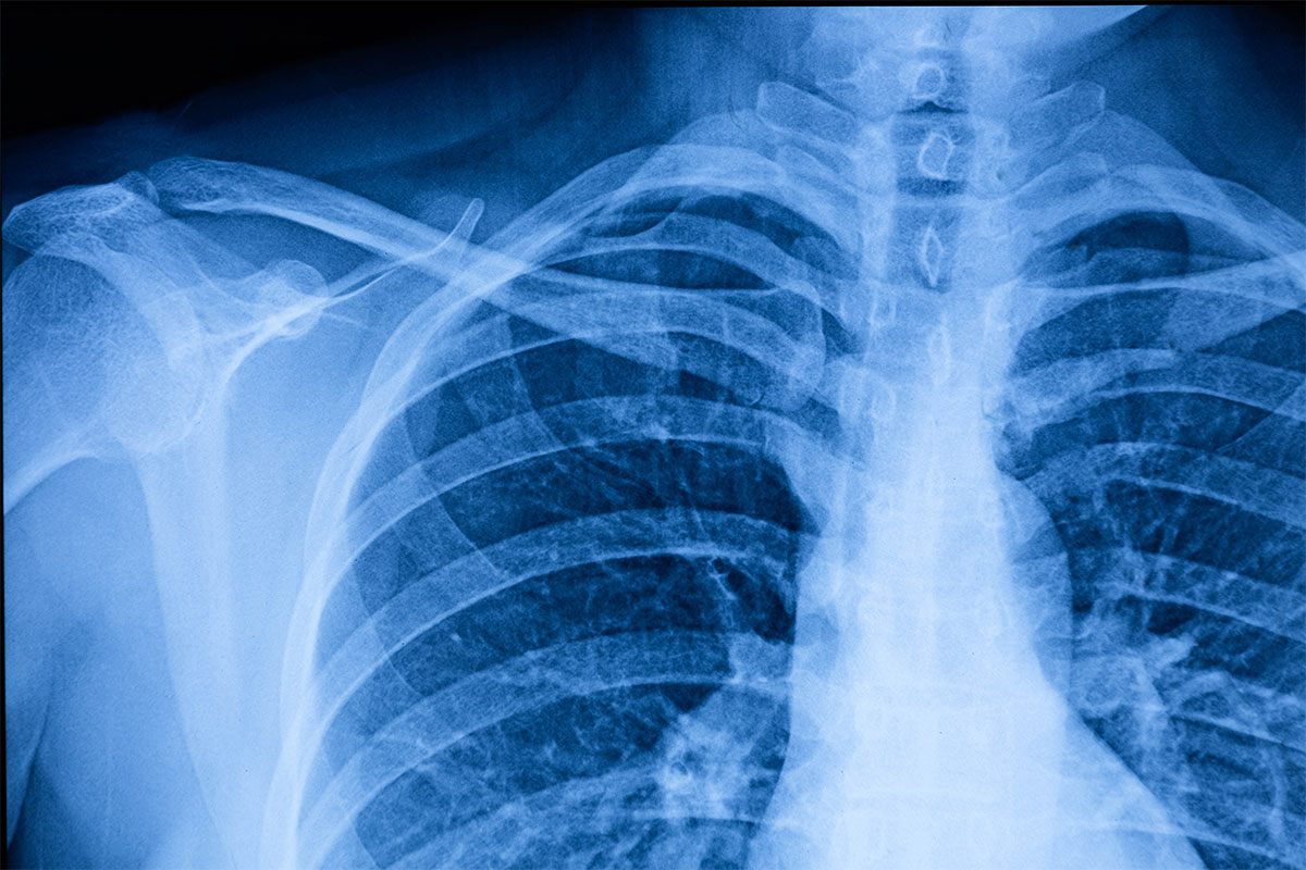 X-ray image from Advanced Urgent Care of Pasadena.